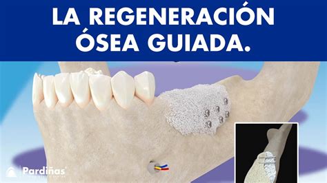Regeneración ósea Guiada ¿se Pueden Colocar Implantes Dentales Sin