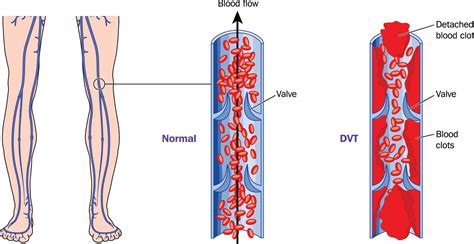 DVT Deep Vein Thrombosis Signs Symptoms Prophylaxis Treatment