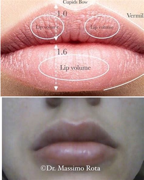 Filler Lips Theory Vs Reality Good Result Good Technique And Material Is The Secret In