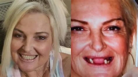 90 Day Fiance Diaries Angela Deems Teeth 😳🥱 Periodontal Disease 🥲