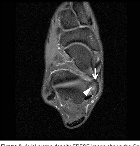 Pdf Tarsal Tunnel Syndrome Associated With Os Sustentaculi A Case