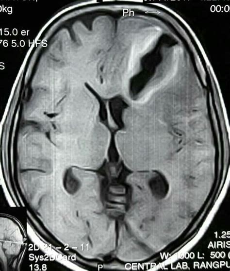 Axial T T W Mri Brain At Level Of Lateral Ventricles Impression