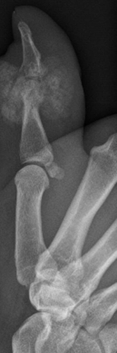 Recurrent Calcifying Aponeurotic Fibroma Of The Thumb Case Report