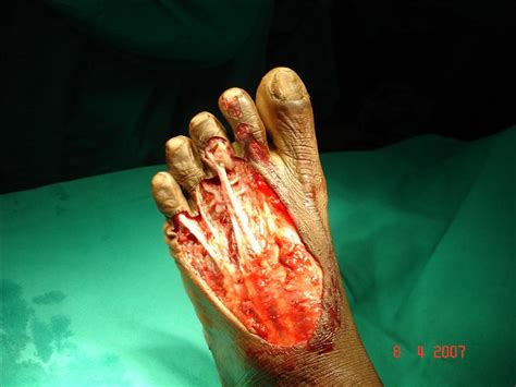 Degloving.....we're not talking about mittens here! - Zombie Squad