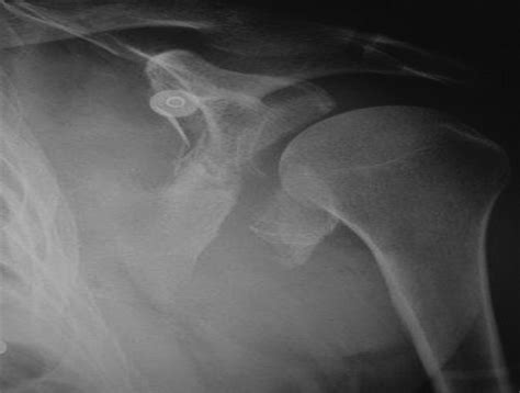 Modified Judet Approach And Minifragment Fixation Of Scapula