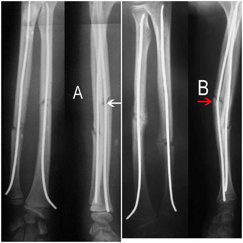 Pdf Retrograde Fixation Of The Ulna In Pediatric Forearm Fractures The Best Porn Website
