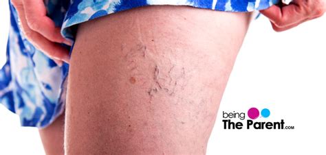 Varicose Veins During Pregnancy Being The Parent