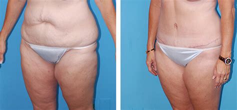 How much do you personally charge to build a relatively simple 5 page website? Boulder Liposuction | Body Contouring Boulder | Boulder ...