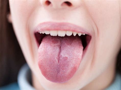 What Are Black Spots On Tongue