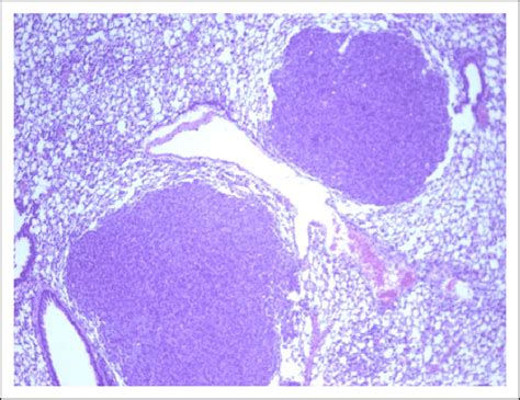 The Histopathological Appearance Of Alveolarbronchiolar Lung Adenomas