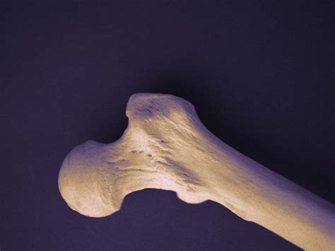 Ppi Use Ups Risk Of Osteoporosis Osteopenia In Femur