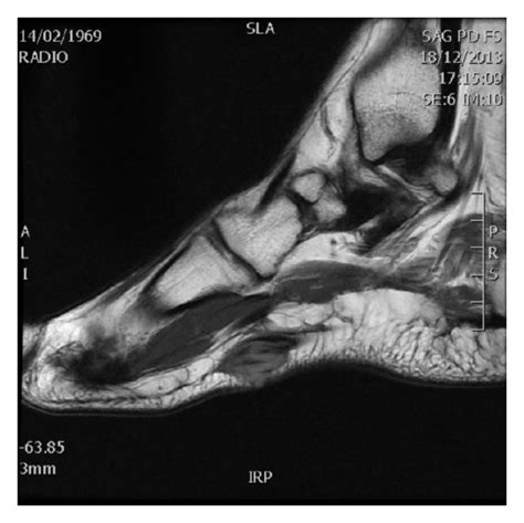 Mri Of The Right Feet Axial T1 Weighted Image Showing Nodular