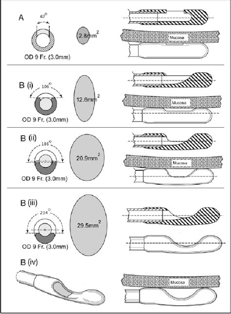 Figure 1 From Dual Purpose Gastric Decompression And Enteral Feeding