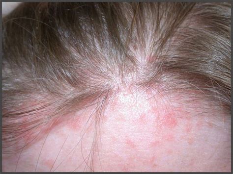 Psoriasis On Forehead Pictures Psoriasis Expert