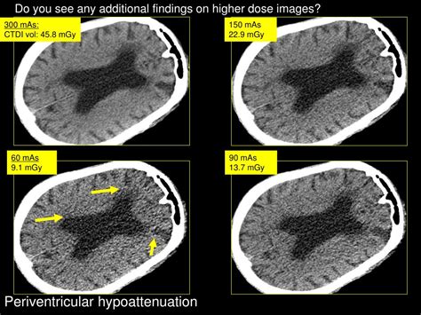 Ppt Image Gallery Lesion Detection On Low Dose Head Ct Powerpoint Presentation Id