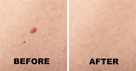 Mole Removal Services Safe And Effective Solutions Leva Medical