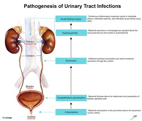 Pathophysiology Of An Uti Urinary Tract Infection Case Study