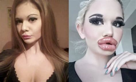la barbie humana se somete a una operación para tener los labios más grandes del mundo