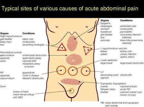 Crampy pain may be due to gas, indigestion, inflammation or infection. Regions of acute abdominal pain .. very important clinically