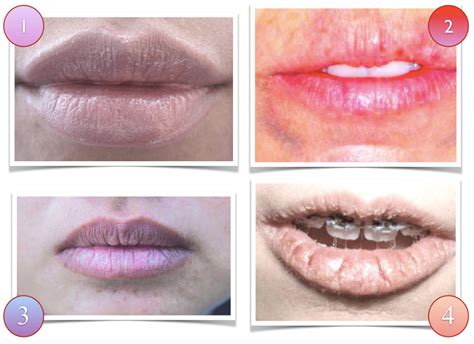 What Causes Pale White Lips