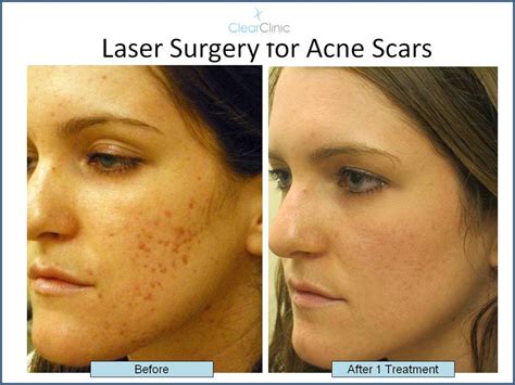 Treating Post Pimple Redness Laser Treatments For Red