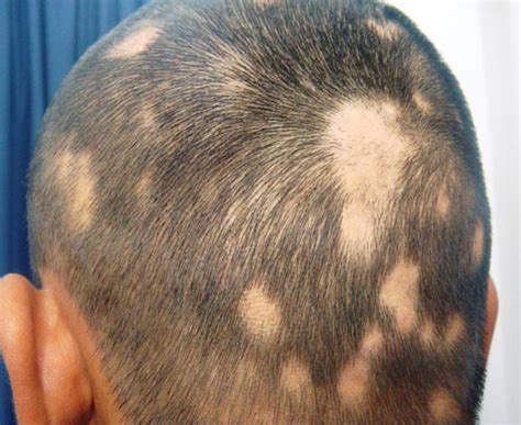 My Best Health Alopecia Areata Hair Loss