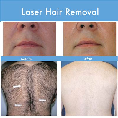 It should feel slightly uncomfortable at times but you should not feel intense pain. Sleek Surgical & MedSpa: Save Yourself From Stubble ...