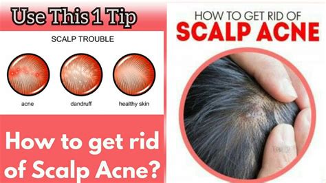 Best Home Remes For Scalp Fungus Bios Pics