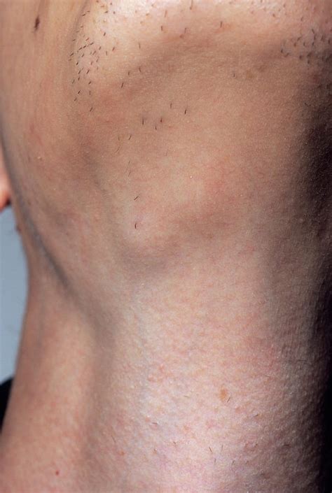 Swollen Glands Photograph By Dr P Marazzi Science Photo Library