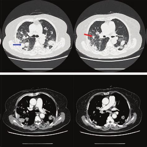 Computed Tomography Ct Images At Admission At Admission Ct Scan