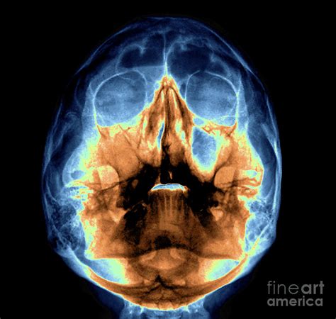 Infected Paranasal Sinuses Photograph By Zephyrscience Photo Library