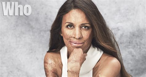 WHO Exclusive Turia Pitt Reveals She Lost Pride In Her Appearance WHO Magazine