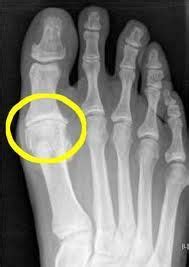 Exposure to dangerous ionizing radiation. XRay of joint compression of the big toe causing arthritis and pain. | Healthy Feet | Pinterest ...