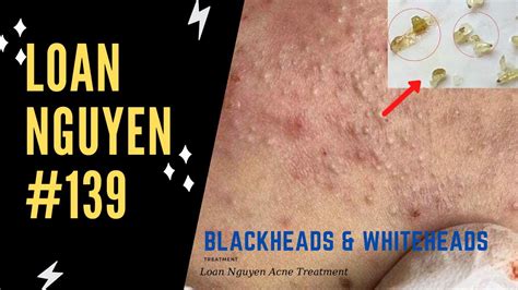 Remove Many Blackheads The Longest Case Of Acne Of The Week 139