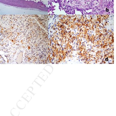 Erythematous Papules Of Benign Cephalic Histiocytosis Download