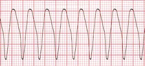 Wide Complex Tachycardia Including Torsades Training Cardiac