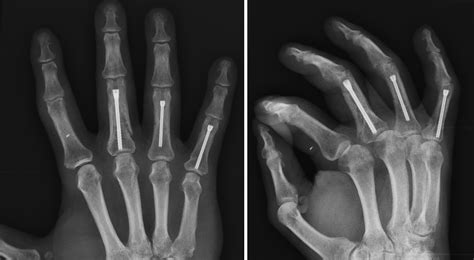 Fingers Fractures Resolution Through Cannulated Screws