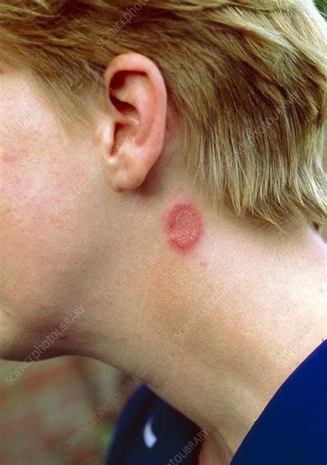 Fungal Infection Ringworm On Neck Stock Image M270 0110 Science