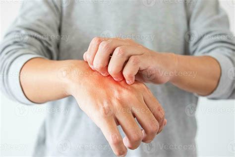 Young Asian Man Itching And Scratching On Hand From Itchy Dry Skin