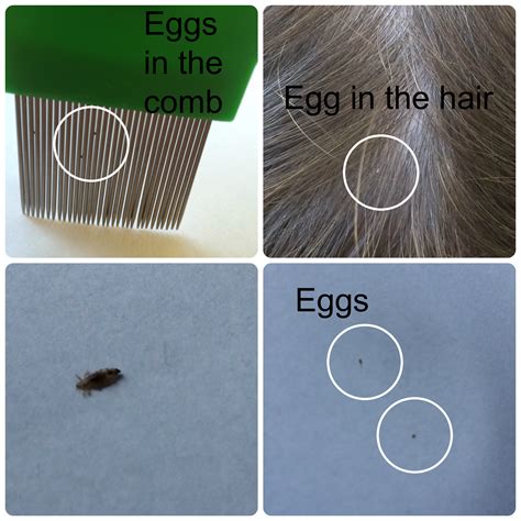 How To Keep Head Lice At Bay Head Lice Prevention Head Louse Head Lice Pictures