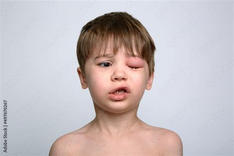 Child With Red Swollen Eye From Insect Bite Quincke Edema Portrait Of