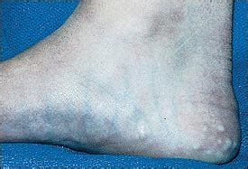 It is caused by excessive sweating or low humidity. Foot Bumps: Now You See Them, Now You Don't - Photo Quiz ...