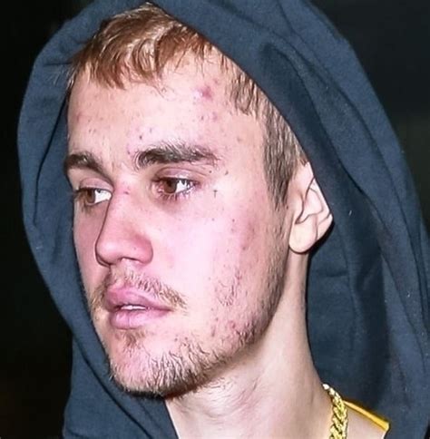 Justin bieber spent much of last year on hiatus, working on his mental and physical health and on becoming a better person and a deeper artist. Justin Bieber reportedly has Lyme disease; suffered ...