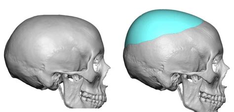 Custom Crown Of Skull Implant Design Side View Dr Barry Eppley