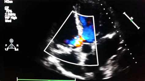 Echocardiogram Perimembranous Ventricular Septal Defects Youtube