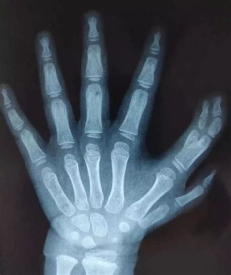 girl born with too many fingers has extra digits surgically removed