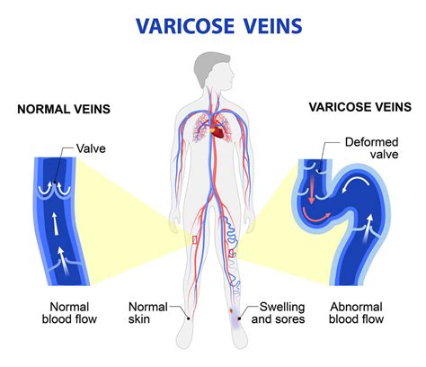 Venous Reflux Disease La Jolla Vein And Vascular Accredited Vein Center