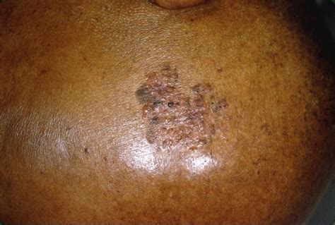 Symptoms Of Skin Cancer On Black People