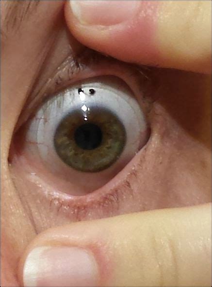 Why do i have this black dot in my eyepiece all of sudden. NEWS UPTO JUNE 7TH 2015 - Neuroptis Dry Eye Project with ...