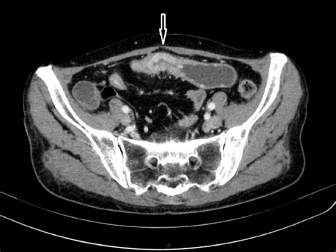 Figure 4 From Imaging Of Obscure Gastrointestinal Bleeding Utility Of